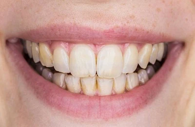 teeth Cleaning before